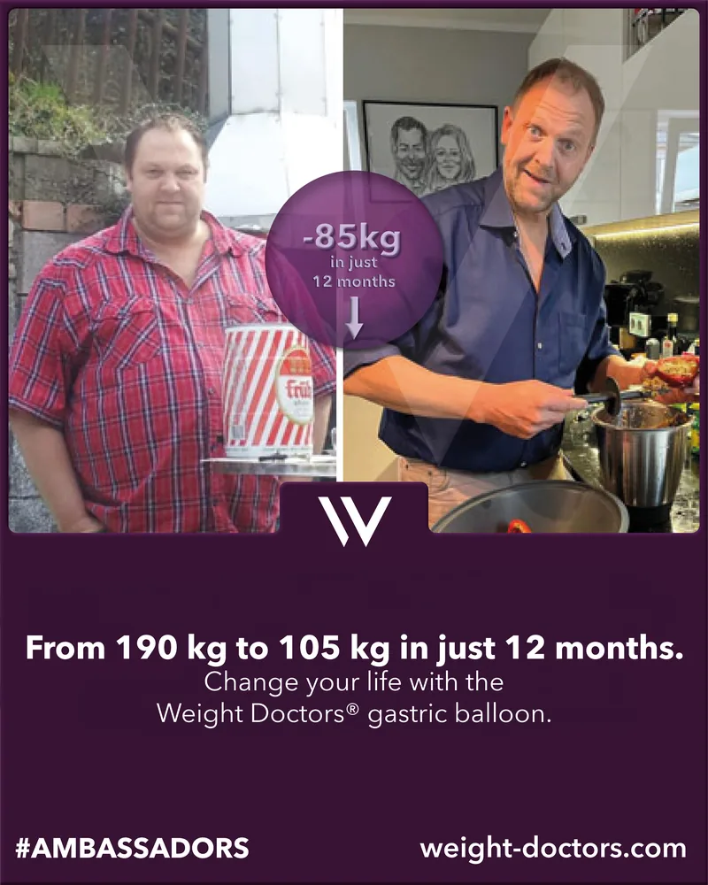 Weight Doctors® before and after: male patient from 190 kg to 105 kg in twelve months, with the Weight Doctors® GASTRIC BALLOON