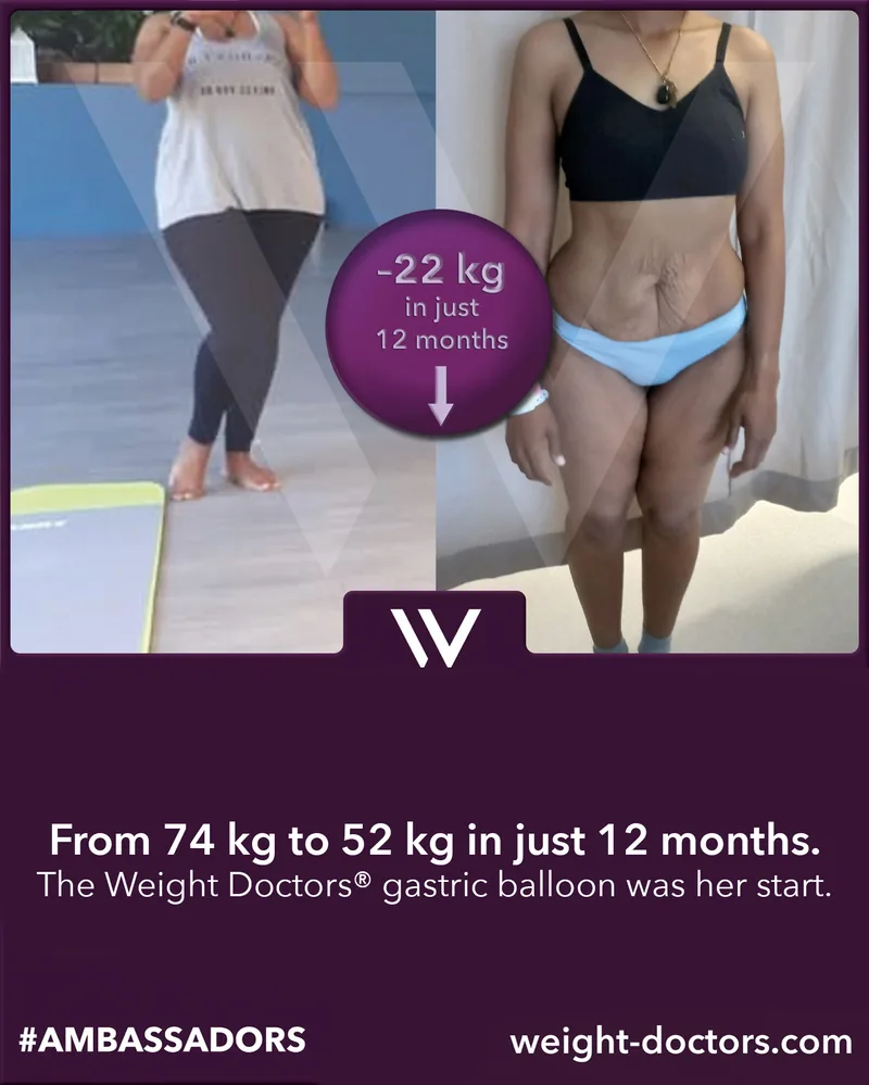 Weight Doctors® before and after: patient from 74 kg to 52 kg in twelve months, with the Weight Doctors® GASTRIC BALLOON
