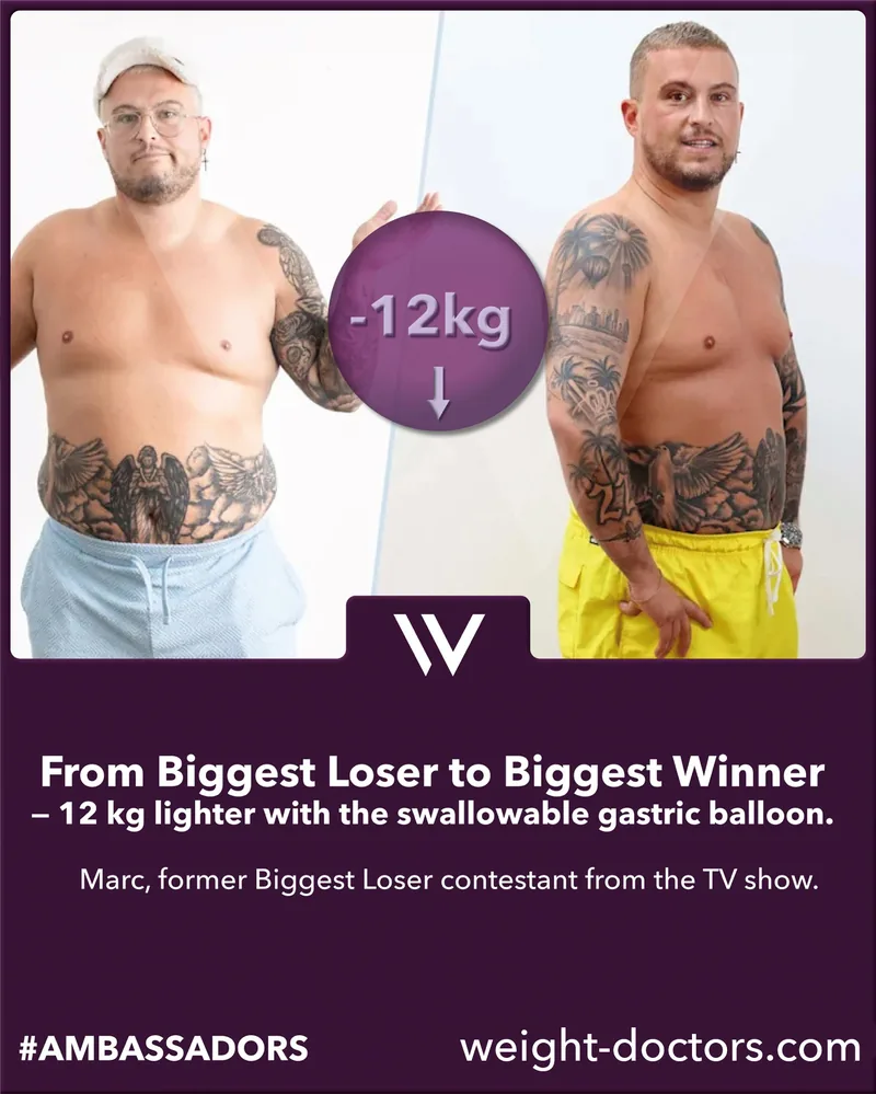 Weight Doctors® before and after: Marc, former contestant on “The Biggest Loser”, 12 kg lighter with the Allurion gastric balloon