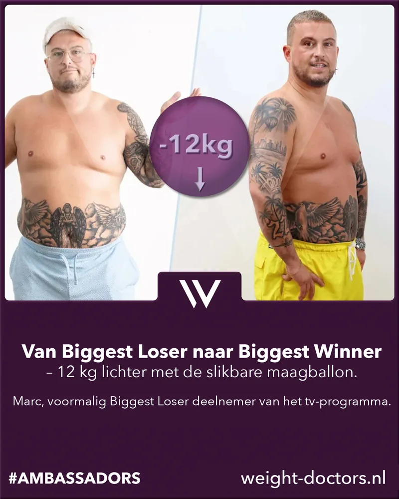 Weight Doctors® voor en na: Marc, voormalig deelnemer aan „The Biggest Loser”, 12 kg minder met de Allurion-maagballon