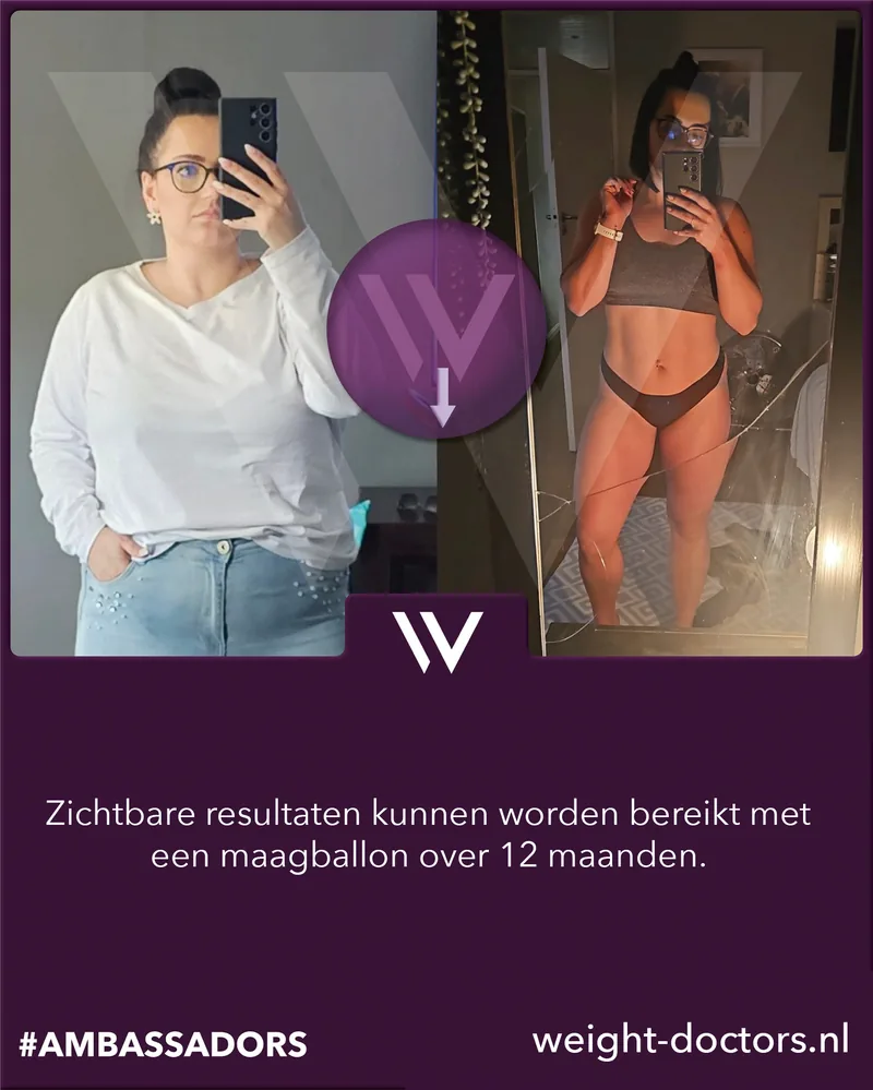 Weight Doctors® voor en na: patiënte voor en na twaalf maanden met de Weight Doctors® MAAGBALLON