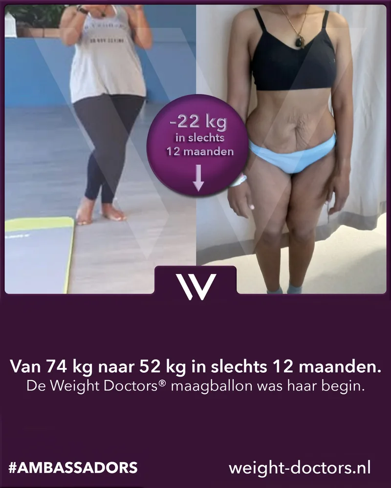 Weight Doctors® voor en na: patiënte van 74 kg naar 52 kg in twaalf maanden, met de Weight Doctors® MAAGBALLON
