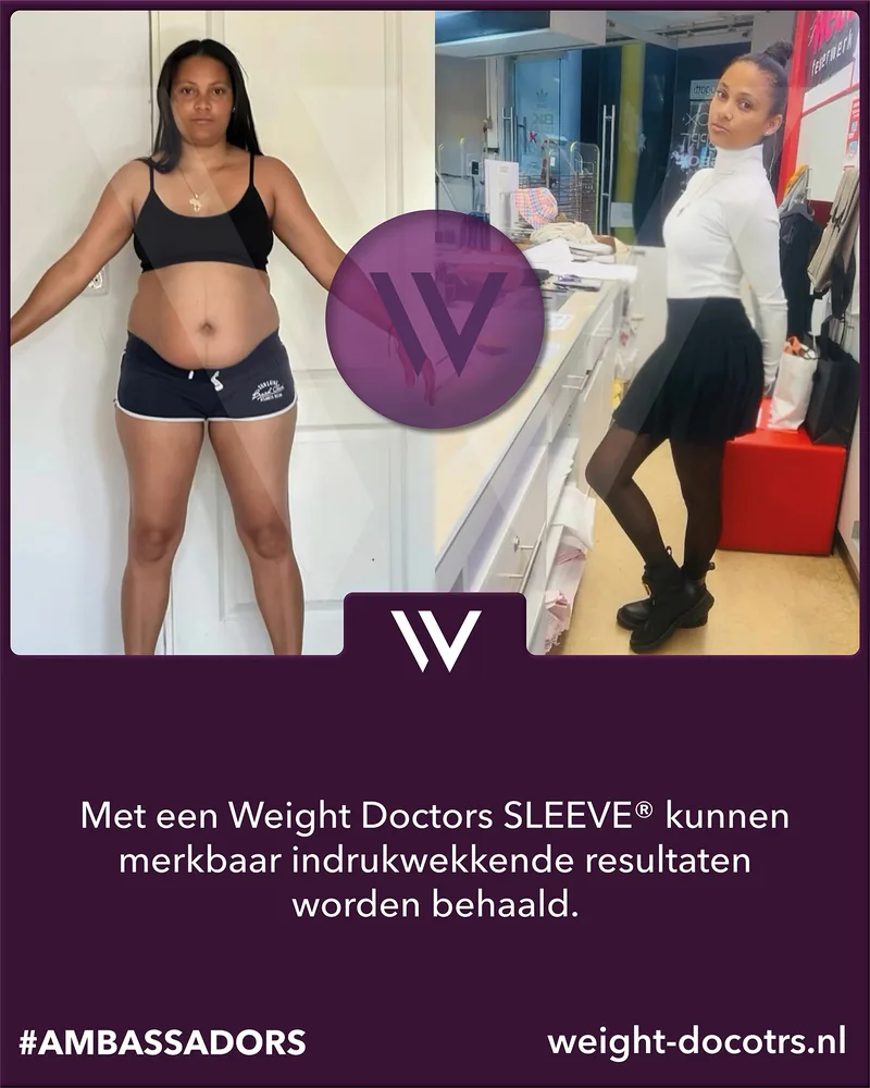 Weight Doctors® voor en na: patiënte voor en na haar Weight Doctors SLEEVE®