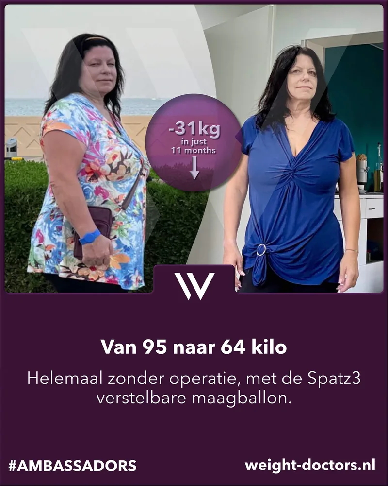 Weight Doctors® voor en na: patiënte van 95 naar 64 kilo geheel zonder operatie, met de regelbare Spatz3-maagballon