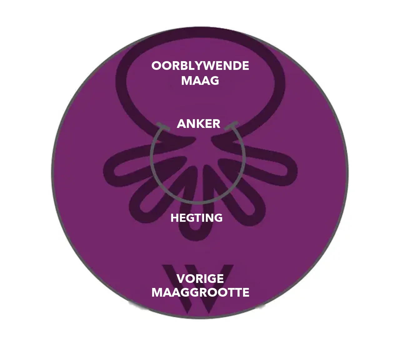 Skema van OverStitch NXT™: ankers en hegting trek die maagwand saam, die oorblywende maag is heelwat kleiner as die vorige maaggrootte