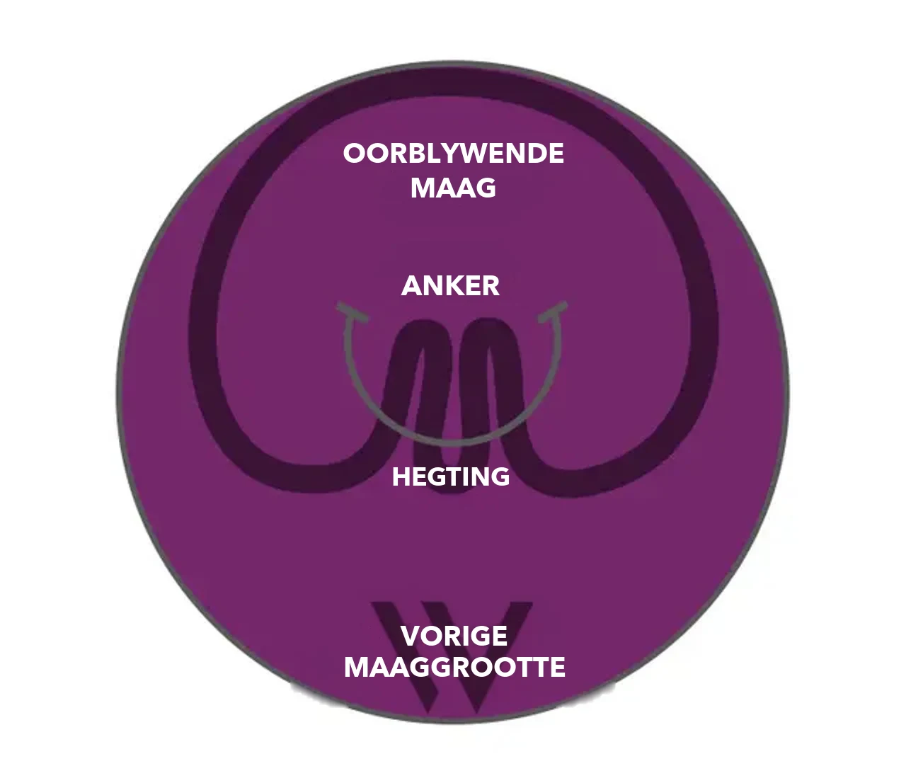 Skematiese tekening: maag ná die saamtrekking met pose® 3.0 Double Helix – oorblywende maag, ankers en naat binne die voormalige maaggrootte