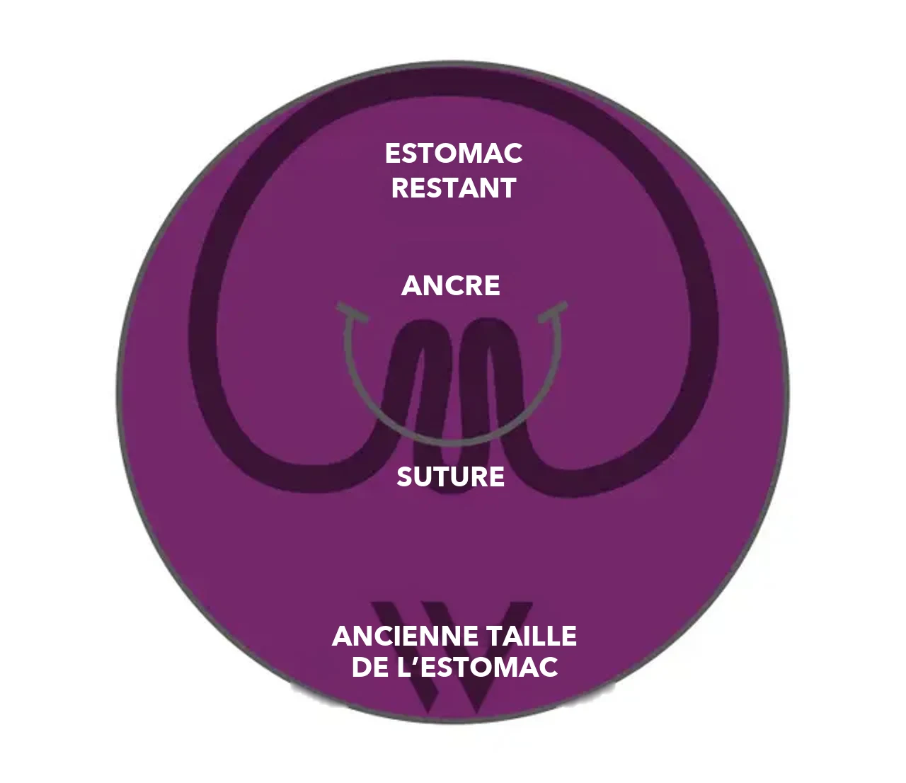 Schéma&nbsp;: estomac après le plissement avec pose® 3.0 Double Helix – estomac restant, ancres et suture à l’intérieur de l’ancienne taille de l’estomac