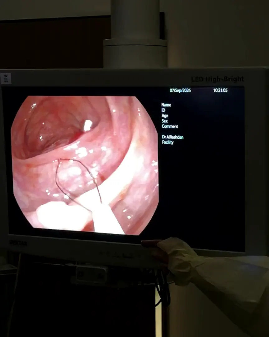Monitor showing the camera image from inside the stomach during a gastroscopy